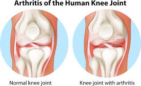 Joint health, knee joint arthritis